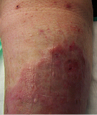 venous leg ulcer after